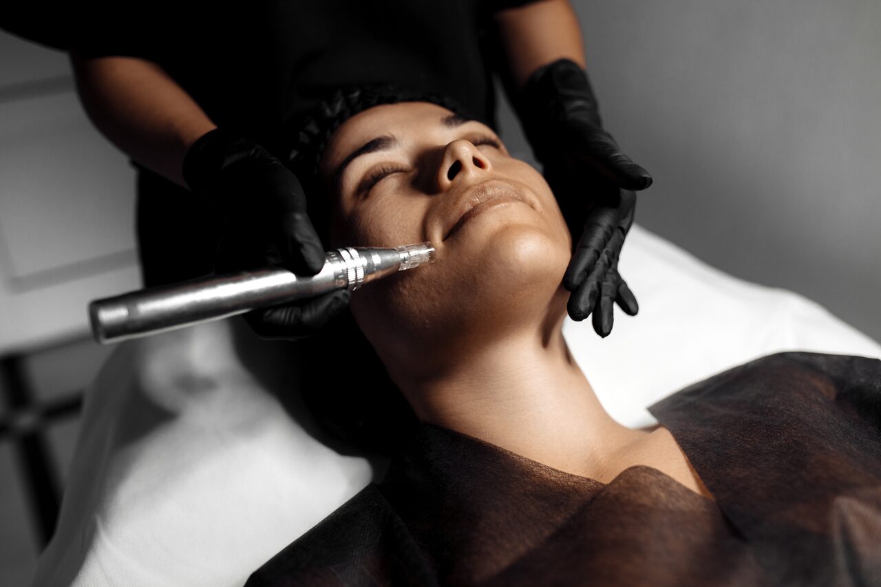 Microneedling Behandlung in Wien Liesing